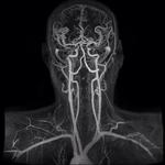 фото МР-артериография головного мозга